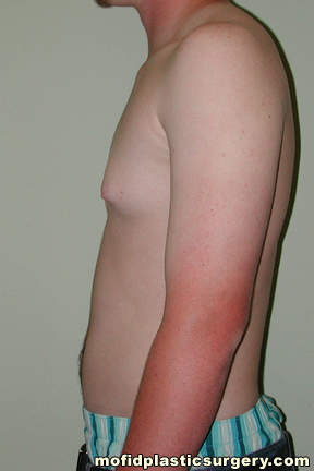 Gynecomastia Case 4734 Before Photo Gynecomastia