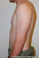 Gynecomastia