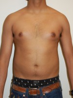 Gynecomastia