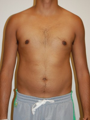 Gynecomastia