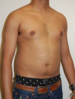 Gynecomastia