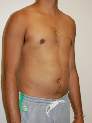 Gynecomastia Case 4740 After Photo Gynecomastia