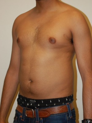 Gynecomastia Case 4740 Before Photo Gynecomastia