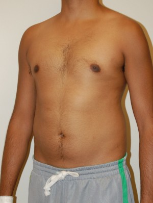 Gynecomastia