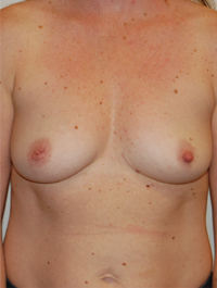 Inverted Nipple Repair Case 4758 Before Photo Inverted Nipple Repair
