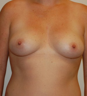 Inverted Nipple Repair