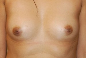 Inverted Nipple Repair Case 4779 Before Photo Inverted Nipple Repair