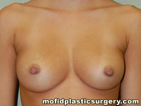 Inverted Nipple Repair Case 4788 After Photo Inverted Nipple Repair