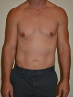 Male Pectoral Implants