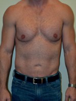 Male Pectoral Implants