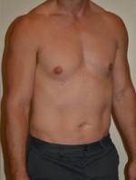 Male Pectoral Implants