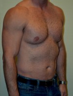 Male Pectoral Implants