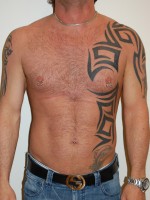 Male Pectoral Implants