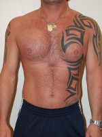 Male Pectoral Implants