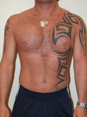 Male Pectoral Implants Case 4776 After Photo Male Pectoral Implants