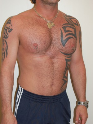 Male Pectoral Implants Case 4776 After Photo Male Pectoral Implants