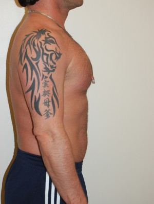 Male Pectoral Implants Case 4776 After Photo Male Pectoral Implants