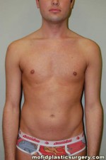 Male Pectoral Implants