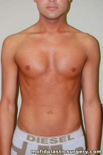 Male Pectoral Implants