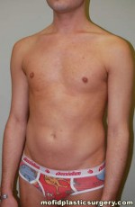 Male Pectoral Implants