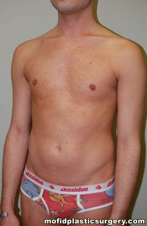 Male Pectoral Implants