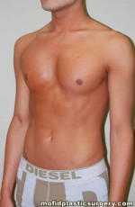 Male Pectoral Implants