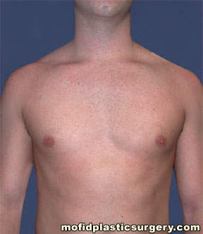 Male Pectoral Implants Case 4824 Before Photo Male Pectoral Implants