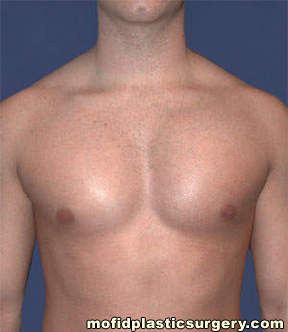 Male Pectoral Implants Case 4824 After Photo Male Pectoral Implants