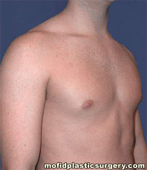 Male Pectoral Implants Case 4824 Before Photo Male Pectoral Implants
