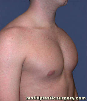 Male Pectoral Implants Case 4824 After Photo Male Pectoral Implants
