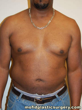 Male Pectoral Implants Case 4830 Before Photo Male Pectoral Implants