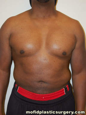 Male Pectoral Implants Case 4830 After Photo Male Pectoral Implants