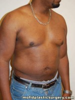 Male Pectoral Implants