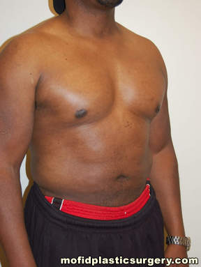 Male Pectoral Implants Case 4830 After Photo Male Pectoral Implants