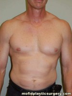 Male Pectoral Implants