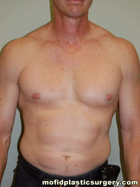 Male Pectoral Implants Case 4838 Before Photo Male Pectoral Implants