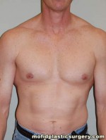 Male Pectoral Implants