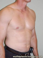 Male Pectoral Implants