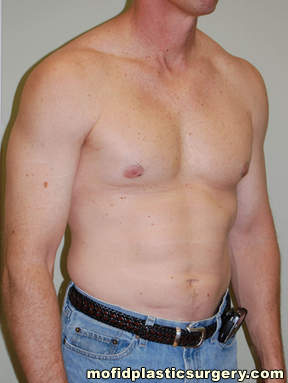 Male Pectoral Implants Case 4838 After Photo Male Pectoral Implants