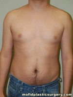 Male Pectoral Implants