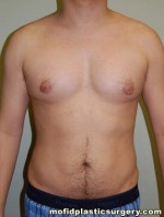 Male Pectoral Implants