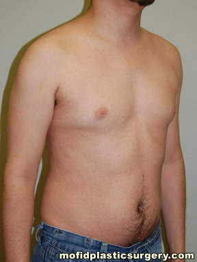 Male Pectoral Implants Case 4844 Before Photo Male Pectoral Implants