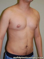 Male Pectoral Implants