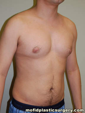 Male Pectoral Implants Case 4844 After Photo Male Pectoral Implants