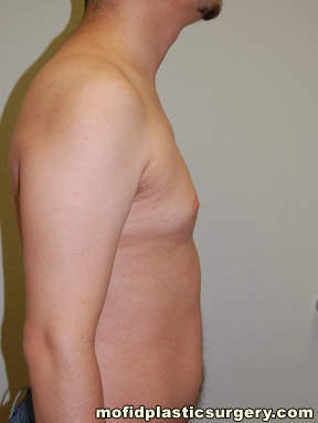Male Pectoral Implants Case 4844 Before Photo Male Pectoral Implants
