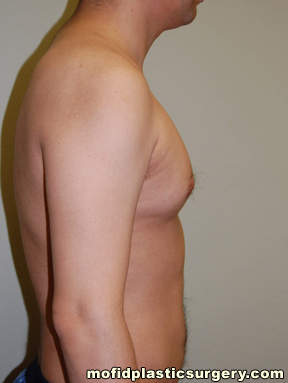 Male Pectoral Implants Case 4844 After Photo Male Pectoral Implants
