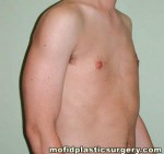 Male Pectoral Implants