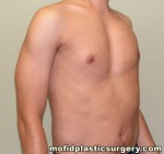 Male Pectoral Implants