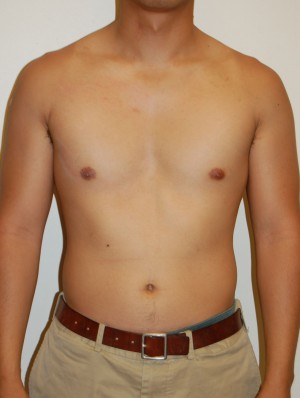 Male Pectoral Implants