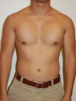 Male Pectoral Implants